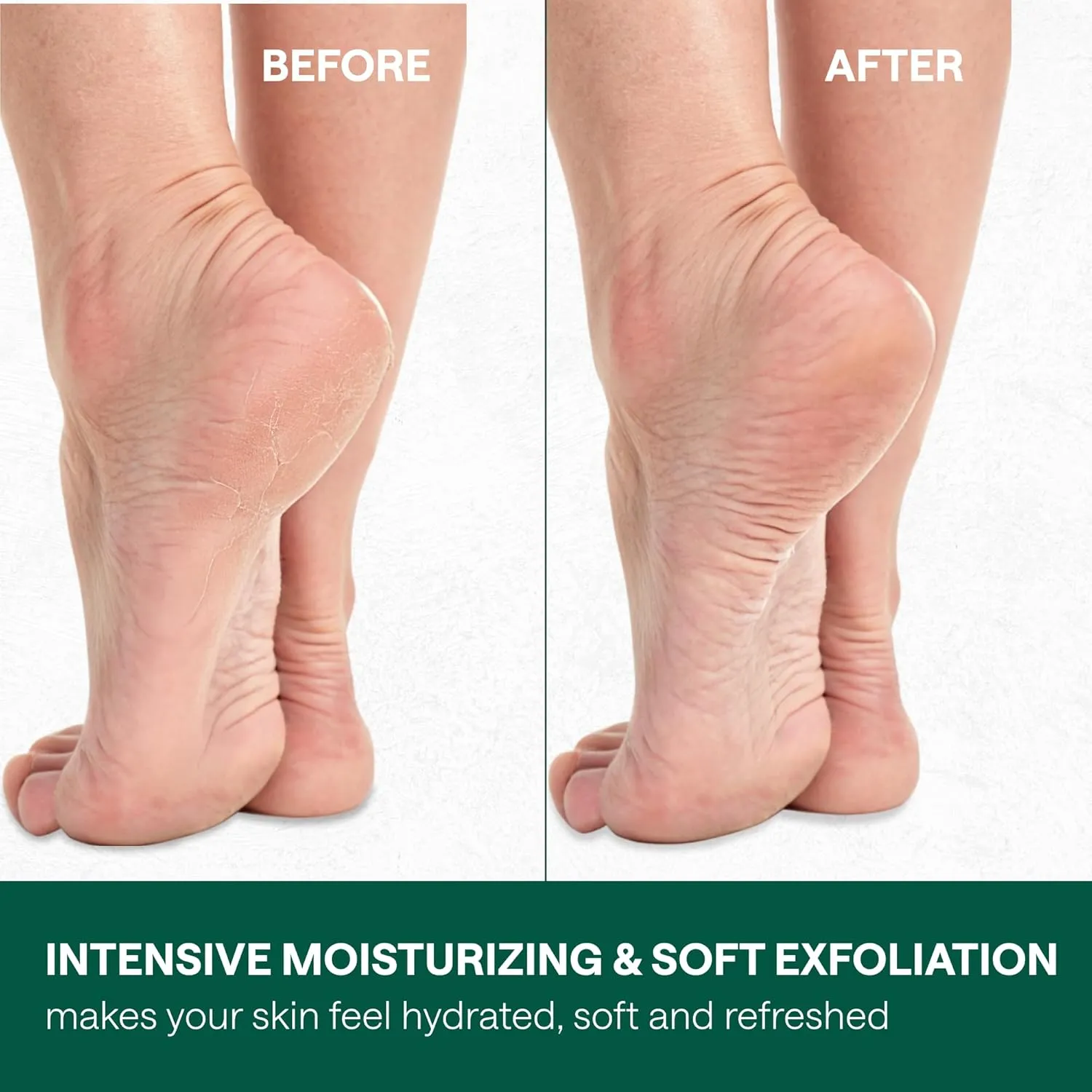 40% Urea Cream for Feet with 2% Salicylic Acid Aloe Tea Tree Oil for Skin - Athletes Foot Cream Extra Strength - Dry Hand Cream for Dry Cracked Hands - Urea Cream 40 Percent, 2 Pack