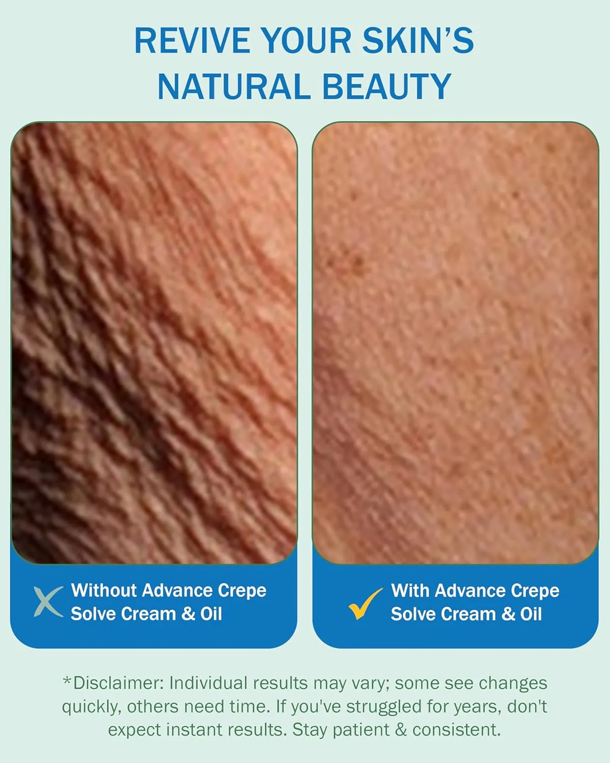 Advance Crepe Solve Body Cream for Women & Men - Made with Natural Oils, Licorice Root & Chamomile Extract - Moisturizer for Dry Skin, Crepey Skin & Stretch Marks, 2-Pack