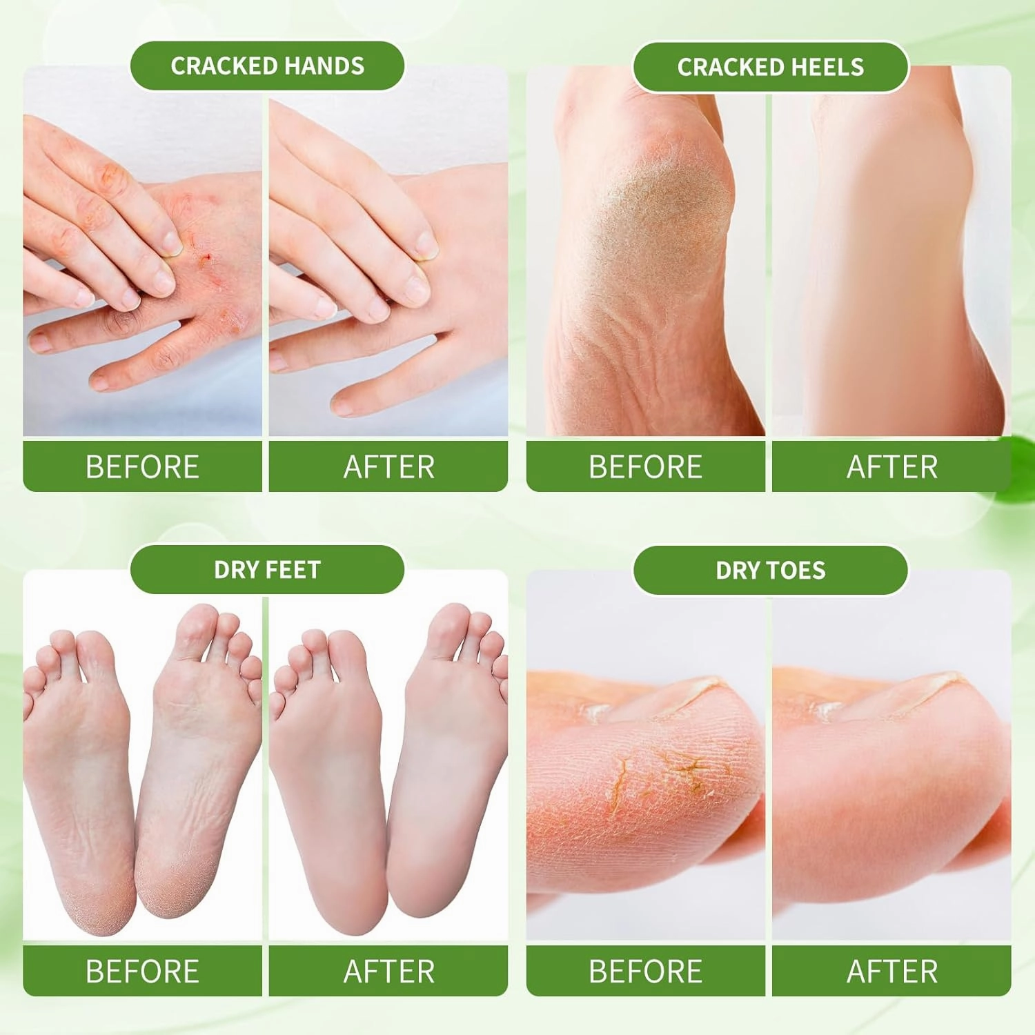 Foot Callus Remover, Hand & Foot Cream, Lotion for Extremely Dry Skin, Athletes Foot Treatment, Pedicure Foot Spa Products for Dry Hands, Cracked Feet, Rough and Dry Skin, 250ml Jasmine