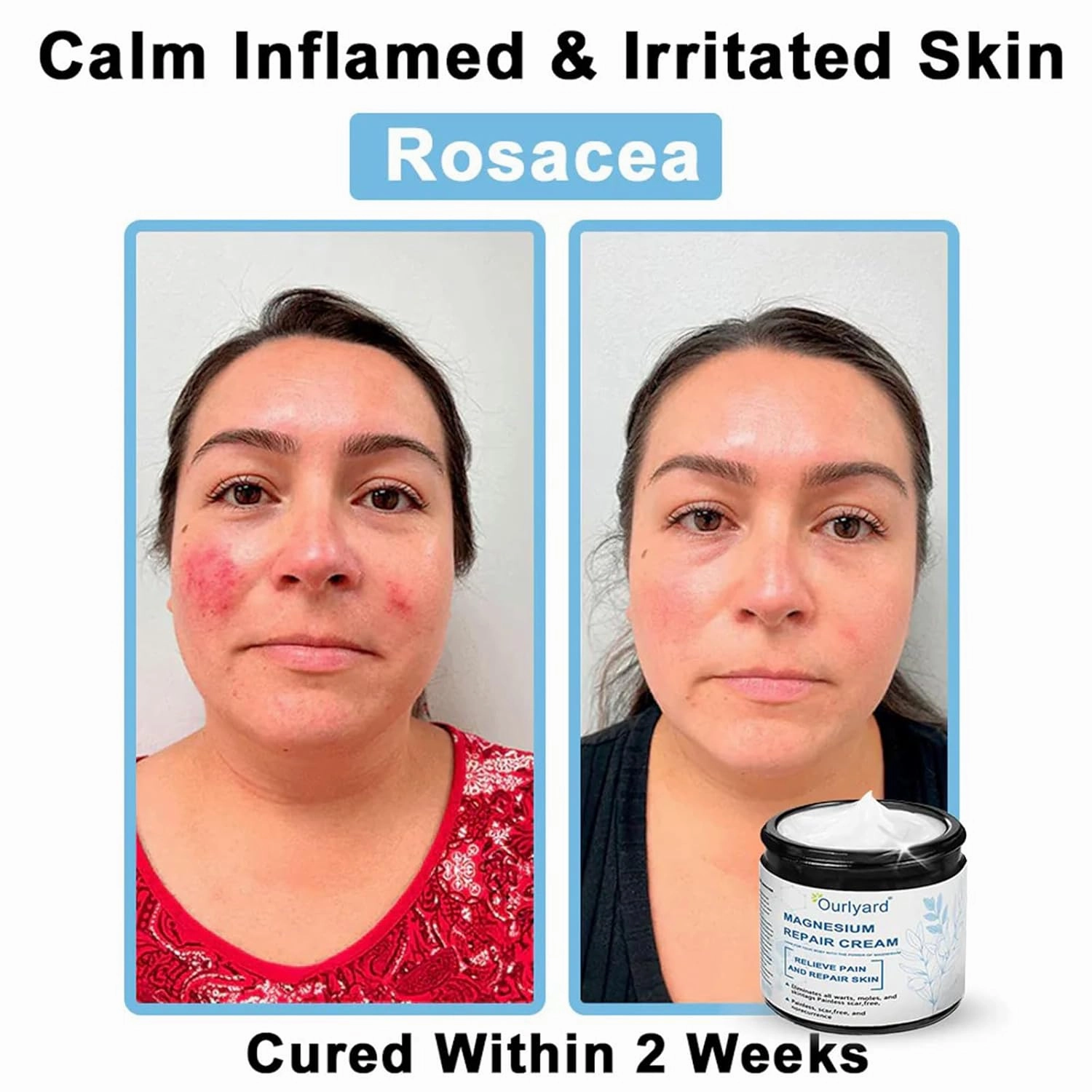Magnesium Skin Repair Cream,2025 New Skin Treatment Cream,Effectively improves skin texture and reduces blemishes (2PCS)